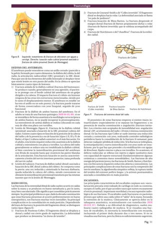 Traumatología
Pág. 11
Figura 8. Izquierda: tratamiento de fractura de olécranon con agujas y
cerclaje. Derecha: luxación radio-cubital proximal asociada a
fractura de cúbito proximal (lesión de Monteggia).
DIÁFISIS DEL ANTEBRAZO.
El antebrazo puede entenderse como un anillo cerrado (parecido a
la pelvis) formado por cuatro elementos: la diáfisis del cúbito, la del
radio, la articulación radiocubital (ARC) proximal y la ARC distal.
Para que uno de los elementos del anillo lesionado se desplace tiene
que existir lesión en otro punto del anillo. En la clínica se aprecian
básicamente cuatro tipos de lesiones:
1) Fractura aislada de la diáfisis cubital (fractura del bastonazo).
Se produce cuando, generalmente en una agresión, el pacien-
te se protege con el borde cubital del antebrazo de un golpe
dirigido a la cabeza. El impacto fractura el cúbito sin lesionar
ninguna de las otras tres estructuras mencionadas, siendo por
lo tanto el desplazamiento menor. El antebrazo es estable (se
ha roto el anillo en un solo punto) y la fractura puede tratarse
de forma conservadora con yeso braquial, seguido de yeso
funcional.
2) Fractura de la diáfisis de ambos huesos del antebrazo. En el
adulto se trata de una fractura quirúrgica (MIR 04-05, 89): si no
sereestablecedeformaanatómicalamorfologíacurvarecíproca
de ambos huesos, no se puede recuperar la pronosupinación.
La osteosíntesis de ambas diáfisis se realiza colocando en cada
una de ellas una placa con tornillos.
3) Lesión de Monteggia (figura 6). Fractura de la diáfisis cubital
(proximal) asociada a luxación de la ARC proximal (cabeza del
radio).Existencuatrotiposenfuncióndelaposicióndelacabeza
del radio y de la presencia o no de luxación (tipos I, II, III y IV de
Bado); el tipo I (cabeza radial a anterior) es el más frecuente. En
el adulto, esta lesión requiere reducción anatómica de la diáfisis
cubital y osteosíntesis con placa y tornillos. La cabeza del radio
generalmente se reduce una vez estabilizada la diáfisis cubital,
si bien conviene la inmovilización provisional del antebrazo
con férula de escayola hasta que cicatricen las partes blandas
de la articulación. Esta fractura-luxación se asocia característi-
camente a lesión del nervio interóseo posterior, rama profunda
del nervio radial.
4) Lesión de Galeazzi. Fractura de diáfisis radial (distal) asociada a
luxación de la ARC distal (cabeza del cúbito). Se comporta como
la previa: una vez reducida y sintetizada la fractura diafisaria,
queda reducida la cabeza del cúbito, siendo conveniente no
obstantelainmovilizaciónprovisionaltransitoriaporlasmismas
razones que en la lesión de Monteggia.
RADIO DISTAL.
Lasfracturasdelaextremidaddistalderadiosuelenocurrirencaídas
sobre la mano y se producen en hueso metafisario y, por lo tanto,
muybienvascularizado.Ellosignificaqueconsolidanprácticamente
siempre.Suprincipalproblemaesque,dadalaelevadaconminución
que estas fracturas presentan al ocurrir preferentemente en hueso
osteoporótico, son fracturas muchas veces inestables. Su principal
complicación es la consolidación en mala posición. Dependiendo
del trazo de fractura y la posición del fragmento distal, se distinguen
varios tipos (figura 8):
1) Fractura de Poutteau-Colles. El fragmento distal se desplaza a
dorsal y radial con cierto grado de supinación. La deformidad
que produce se denomina “en dorso de tenedor”.
2) Fractura de Goyrand-Smith o de“Colles invertido”. El fragmento
distal se desplaza hacia volar. La deformidad asociada se llama
“en pala de jardinero”.
3) Fractura-luxación de Rhea-Barton. La fractura desprende el
margen dorsal (fractura de Barton propiamente dicha) o volar
(fractura de Barton invertida) que se subluxa acompañado del
carpo.
4) Fractura de Hutchinson o del“chauffeur”. Fractura de la estiloi-
des radial.
Figura 9. Fracturas del extremo distal del radio.
El pronóstico de estas fracturas empeora si existen trazos in-
traarticulares (especialmente si se separan los fragmentos) y en
presencia de mucha conminución o angulación (fractura inesta-
ble). Los criterios más aceptados de inestabilidad son: angulación
dorsal >20º, acortamiento del radio >10 mm e intensa conminución
dorsal. En las fracturas tipo Colles se suele intentar una reducción
cerrada y contención con yeso, realizando controles radiológicos
periódicos hasta la consolidación de la fractura (6 semanas) para
detectar cualquier pérdida de reducción. Si la fractura se redesplaza,
la remanipulación y nueva inmovilización con yeso suele ser insu-
ficiente, por lo que hay que proceder a la estabilización con agujas
de Kirschner, fijador externo o placa con tornillos. En ocasiones, el
defecto trabecular se rellena con injerto o algún sustitutivo óseo
con capacidad de soporte estructural (fundamentalmente algunas
cerámicas o cementos óseos remodelables). Las fracturas de alta
energíadelpacientejovenylasfracturasdeSmith,BartonyHutchin-
son con frecuencia requieren reducción abierta y osteosíntesis. Las
principales complicaciones de estas fracturas son la compresión del
nervio mediano, la algodistrofia simpático refleja, la ruptura tardía
del tendón del extensor pollicis longus y la artrosis postraumática
asociada a consolidación en mala posición.
ESCAFOIDES.
Las principales características del escafoides carpiano son: vascu-
larización precaria (está rodeado de cartílago en todo su contorno,
excepto el cuello, por el que acceden vasos que nutren escasamente
el tercio proximal); importante movilidad y escasa expresión radio-
lógica de sus fracturas. El escafoides suele fracturarse en pacientes
jóvenes que sufren una caída sobre el “talón” de la mano, forzando
la extensión de la muñeca. Clínicamente se aprecia dolor en la
tabaquera anatómica, ocasionalmente con tumefacción (MIR
00-01F, 87). Debido a su dificultad de diagnóstico, suelen rea-
lizarse cuatro radiografías de muñeca. Si se visualiza una frac-
tura de escafoides, es necesaria la inmovilización con escayola,
incluyendo el primer dedo durante dos o tres meses. Si no se
visualiza una fractura, pero la clínica es suficientemente sugerente,
 