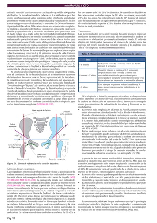 miniMANUAL 1 CTO
Pág. 20
sobre la zona del trocánter mayor, con la cadera y rodilla a 90 grados
de flexión. La introducción de la cabeza en el acetábulo se percibe
como un chasquido al saltar la cabeza sobre el reborde acetabular
posterior y revela que la cadera estaba luxada y es reductible. En los
casos más graves o evolucionados, la maniobra de Ortolani no con-
sigue reducir la cadera. Si la cadera tiene una separación completa,
se realiza la maniobra de Barlow. Consiste en colocar la cadera en
flexión y aproximación y la rodilla en flexión para presionar con
el dedo pulgar en la ingle sobre la extremidad proximal del fémur,
tratandodedesplazarlaensentidoposteriorhastapercibirunresalte
o chasquido que coincide con la luxación de la cabeza; indica que
una cadera es luxable. Por lo tanto, el diagnóstico clínico de luxación
congénita de cadera se realiza cuando se encuentre alguna de estas
tres alteraciones: limitación de la abducción, maniobra de Ortolani
o maniobra de Barlow. Es aconsejable que esta exploración se repita
a las 6 semanas y entre los 6 y 10 primeros meses de vida. Existen
algunos neonatos en los que la única alteración que se detecta en la
exploración es un chasquido o “click” de la cadera, que en muchas
ocasiones carece de significado patológico. La ecografía es la prueba
de elección para valorar estos chasquidos y permite etiquetar la
cadera como normal o displásica. Otros hallazgos clínicos como la
asimetría de pliegues glúteos son menos valorables.
Si una luxación congénita de cadera no se diagnostica y trata,
con el comienzo de la deambulación, el acortamiento aparente
del miembro, la contractura en flexo y aproximación de la cadera,
la rotación externa del miembro y la insuficiencia del aparato ab-
ductor se traducen en un caminar en el que destaca la marcha de
Trendelenburg o “de pato”: al caminar, el paciente desvía el tronco
hacia el lado de la luxación. El signo de Trendelenburg se aprecia
viendo al paciente desde posterior en apoyo monopodal: la pelvis
desciendeenelladoopuestohastaquelainclinacióncompensadora
del tronco y la tensión de los abductores equilibran el cuerpo. El
desarrollo de artrosis secundaria sintomática a largo plazo parece
ser más frecuente en las caderas con subluxación o displasia que
en las luxaciones completas (MIR 98-99, 197).
Figura 21. Líneas de referencia en la luxación de cadera.
MÉTODOS COMPLEMENTARIOS.
La ecografía es el método de elección para valorar la patología de la
caderaneonatal,auncuandotodavíanosehanosificadoloselemen-
tos articulares, así como para detectar colecciones de líquido (MIR
97-98F, 202; MIR 96-97, 259). La radiografía simple es el método de
elección para valorar la displasia de cadera a partir de los tres meses
(MIR 00-01F, 88); para valorar la posición de la cabeza femoral se
toma como referencia la línea que une ambos cartílagos fisarios
trirradiados (línea de Hilgenreiner), la vertical tangente al reborde
acetabular superolateral (línea de Perkins) y la línea cervicoobtu-
ratriz (de Shenton); estas líneas permiten apreciar diferencias de
posición entre la cadera patológica y la normal (figura 18). El ángulo
o índice acetabular, formado entre las líneas que desde el reborde
acetabular inferomedial se dirigen una horizontalmente y la otra
hacia el reborde acetabular superolateral. El índice acetabular es
el parámetro más útil para seguir la evolución de la cadera tras la
reducción. La cadera normal tiene un índice acetabular de 20 a 25º a
los tres meses y de 18 a 21º a los dos años. Se consideran displásicas
las caderas con un índice mayor de 28º a los tres meses y mayor de
24º a los dos años. Su reducción en más de 10º durante el primer
año de tratamiento es un signo de buen pronóstico; por el contrario,
si continúa siendo superior a 25º a los dos años de seguimiento, es
factor de mal pronóstico.
TRATAMIENTO.
Las deformidades de la enfermedad luxante pueden regresar
mediante la remodelación asociada al crecimiento si la cadera se
mantiene en abducción, previa reducción si está luxada. El método
clásico del doble pañal (aumentar el número de pañales entre las
piernas del recién nacido) ha perdido vigencia y las caderas con
“click” sin displasia no requieren tratamiento.
Tabla 7. Resumen del tratamiento de la displasia de cadera.
d
a
d
E o
t
n
e
i
m
a
t
a
r
T
s
e
s
e
m
6
<
)
k
i
l
v
a
P
e
d
s
é
n
r
a
(
s
i
s
e
t
r
o
+
a
d
a
r
r
e
c
n
ó
i
c
c
u
d
e
R
s
a
n
a
m
e
s
6
e
t
n
a
r
u
d
s
o
ñ
a
2
-
s
e
s
e
m
6
,
)
s
a
n
a
m
e
s
3
-
2
(
a
e
n
á
t
u
c
o
a
d
n
a
l
b
n
ó
i
c
c
a
r
T
n
o
s
s
e
c
e
v
a
(
a
d
a
r
r
e
c
n
ó
i
c
c
u
d
e
r
s
é
u
p
s
e
d
a
r
a
p
s
a
e
n
á
t
u
c
r
e
p
s
a
í
m
o
t
o
n
e
t
s
a
i
r
a
s
e
c
e
n
.
o
s
e
y
n
o
c
n
ó
i
c
a
z
i
l
i
v
o
m
n
i
s
é
u
p
s
e
d
y
)
a
l
r
i
u
g
e
s
n
o
c
.
a
t
r
e
i
b
a
n
ó
i
c
c
u
d
e
r
a
l
a
i
r
a
s
e
c
e
n
s
e
s
e
n
o
i
s
a
c
o
n
E
s
o
ñ
a
2
>
A
.
a
t
r
e
i
b
a
n
ó
i
c
c
u
d
e
r
n
e
r
e
i
u
q
e
r
e
r
p
m
e
i
s
i
s
a
C
a
l
a
s
a
í
m
o
t
o
e
t
s
o
r
a
i
c
o
s
a
o
i
r
a
s
e
c
e
n
s
e
s
e
c
e
v
.
n
ó
i
c
c
u
d
e
r
Si la displasia o luxación congénita de cadera se diagnostican
en los primeros seis meses de vida, el uso de ortesis que mantienen
la cadera en abducción es bastante eficaz, tanto para conseguir
como para mantener la reducción de la cadera y favorecer su re-
modelación.
• La ortesis más empleada es el arnés de Pavlik, aunque existen
otras alternativas (almohadón de Frejka, férula deVonRossen).
Cuando el tratamiento se inicia al nacimiento, el arnés se man-
tiene a tiempo completo durante 2 ó 3 meses y a tiempo parcial
1 ó 2 meses más, retirándolo cuando se consigue una abducción
completa y simétrica, no hay inestabilidad y el índice acetabular
es menor de 30º. Este régimen tiene un porcentaje de fracaso
del 15% al 20%.
• En las caderas que no se reducen con el arnés, mantenerlas en
flexión y separación puede aumentar el defecto acetabular pos-
terolateral y la dificultad para reducir la cadera, circunstancia
denominada “enfermedad del arnés de Pavlik”. Estas caderas no
reductibles con el arnés pueden generalmente tratarse mediante
reducción cerrada e inmovilización con espica de yeso. La cadera
debecolocarseennomásde45a55gradosdeabducción(posición
humana) para reducir el riesgo de necrosis avascular. La confir-
mación de la reducción se obtiene con artrografía y/o TAC.
A partir de los seis meses resulta difícil inmovilizar niños más
grandes y cada vez más activos en un arnés de Pavlik. Más aún, los
cambios patológicos del niño mayor impiden la consecución de la
reducción con el simple uso del arnés y las tasas de fracaso superan
el 50%. El tratamiento varía, dependiendo de si el niño tiene más o
menos de 18 meses. Existen algunos detalles a destacar:
• La reducción cerrada puede requerir la asociación de tenotomía
de los adductores; el valor de la tracción preoperatoria es con-
trovertido y cada vez más cirujanos se decantan por no usarla.
• La reducción abierta suele requerirse especialmente a partir de
los 18 meses.
• El objetivo de las osteotomías femorales es fundamentalmente
acortar el fémur para facilitar la reducción y reducir la incidencia
de osteonecrosis por exceso de presión. No obstante, también
se aprovecha para reducir la anteversión.
La osteotomía pélvica es la que realmente corrige la patología
más importante de la displasia. La más empleada es la osteotomía
innominada de Salter, aunque muchos cirujanos se decantan por
la realización de otras osteotomías (Pemberton, Dega, etc).
 