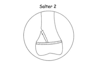 Salter 2
 