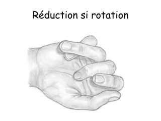 Réduction si rotation
 
