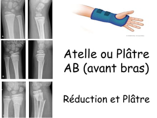 Atelle ou Plâtre
AB (avant bras)
Réduction et Plâtre
 