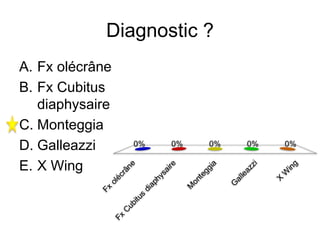 Diagnostic ?
A. Fx olécrâne
B. Fx Cubitus
diaphysaire
C. Monteggia
D. Galleazzi
E. X Wing
 