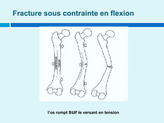 Fracture sous contrainte en flexion
l’os rompt sur le versant en tension
 