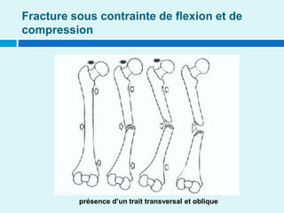 Fracture sous contrainte de flexion et de
compression
présence d’un trait transversal et oblique
 
