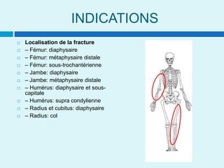 INDICATIONS
 Localisation de la fracture
 – Fémur: diaphysaire
 – Fémur: métaphysaire distale
 – Fémur: sous-trochantérienne
 – Jambe: diaphysaire
 – Jambe: métaphysaire distale
 – Humérus: diaphysaire et sous-
capitale
 – Humérus: supra condylienne
 – Radius et cubitus: diaphysaire
 – Radius: col
 