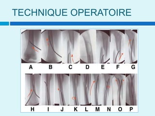 TECHNIQUE OPERATOIRE
 