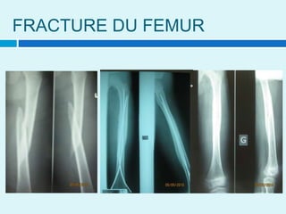 FRACTURE DU FEMUR
 