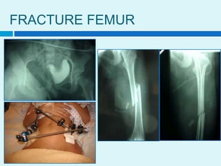 FRACTURE FEMUR
 