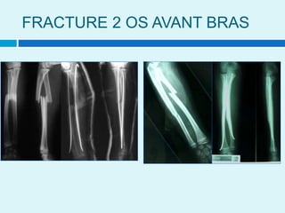 FRACTURE 2 OS AVANT BRAS
 