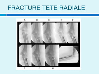 FRACTURE TETE RADIALE
 