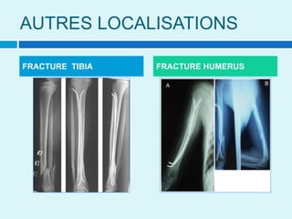 AUTRES LOCALISATIONS
FRACTURE TIBIA FRACTURE HUMERUS
 