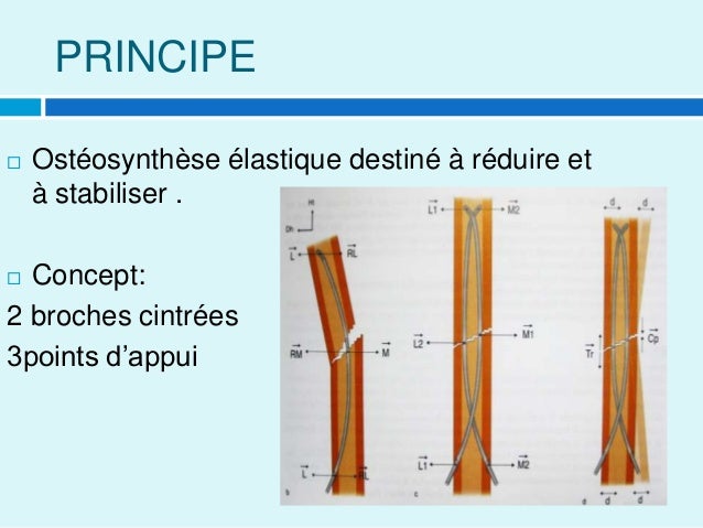 L'embrochage centromédullaire élastique stable (ECMES) chez l'enfant
