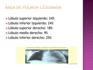 Contusión PulmonarPrincipalmente  relacionada con trauma cerrado cuando la glotis esta cerrada.  La seriedad varia desde el pequeño hematoma pulmonar hasta el llamado pulmón traumático que usualmente aparece mas tardíamente.  Lo que mas empeora el pronostico de estos pacientes es la sobrecarga de fluidos; por lo tanto, los líquidos intravenosos deben ser limitados a 1000 mL en la resucitación inicial y a 30 mL por Kg/hora durante las siguientes 72 horas, asegurándose de que no haya ninguna lesión asociada que requiera tratamiento diferente.  También el uso de diuréticos, fisioterapia y esteroides, son parte del tratamiento.La mejor forma de valorar el daño pulmonar en trauma de tórax es la tomografía axial computadorizada