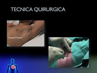 TECNICA QUIRURGICA
 