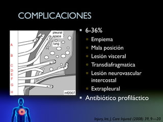 COMPLICACIONES
            6-36%
              Empiema
              Mala posición
              Lesión visceral
              Transdiafragmatica
              Lesión neurovascular
               intercostal
              Extrapleural
            Antibiótico profiláctico


                 Injury, Int. J. Care Injured (2008) 39, 9—20
 