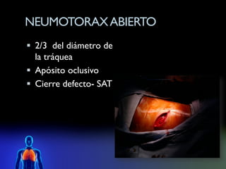 NEUMOTORAX ABIERTO
 2/3 del diámetro de
  la tráquea
 Apósito oclusivo
 Cierre defecto- SAT
 