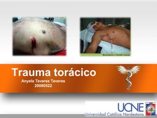 Trauma torácico
Anyela Tavarez Taveras
20080522
 