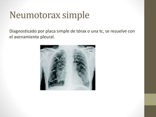 Neumotorax simple
Diagnosticado por placa simple de tórax o una tc, se resuelve con
el avenamiento pleural.
 