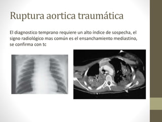 Ruptura aortica traumática
El diagnostico temprano requiere un alto índice de sospecha, el
signo radiológico mas común es el ensanchamiento mediastino,
se confirma con tc
 