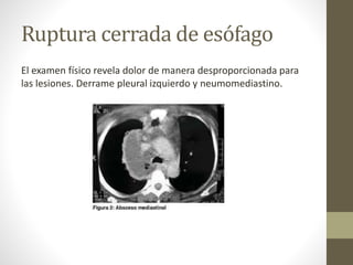 Ruptura cerrada de esófago
El examen físico revela dolor de manera desproporcionada para
las lesiones. Derrame pleural izquierdo y neumomediastino.
 