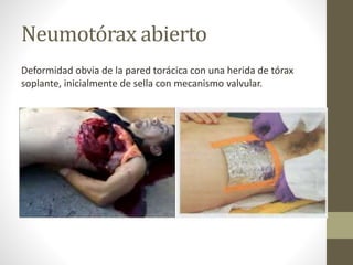 Neumotórax abierto
Deformidad obvia de la pared torácica con una herida de tórax
soplante, inicialmente de sella con mecanismo valvular.
 