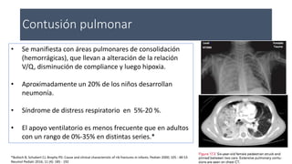 Contusión pulmonar
• Se manifiesta con áreas pulmonares de consolidación
(hemorrágicas), que llevan a alteración de la relación
V/Q, disminución de compliance y luego hipoxia.
• Aproximadamente un 20% de los niños desarrollan
neumonía.
• Síndrome de distress respiratorio en 5%-20 %.
• El apoyo ventilatorio es menos frecuente que en adultos
con un rango de 0%-35% en distintas series.*
*Bulloch B, Schubert CJ, Brophy PD. Cause and clinical characteristic of rib fractures in infants. Pediatr 2000; 105 : 48-53
Neumol Pediatr 2016; 11 (4): 185 - 192
 
