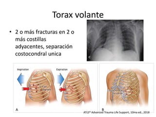 Torax volante
• 2 o más fracturas en 2 o
más costillas
adyacentes, separación
costocondral unica
ATLS® Advanced Trauma Life Support, 10ma ed., 2018
 