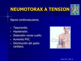 NEUMOTORAX A TENSION

Signos cardiovasculares.

   Taquicardia.
   Hipotensión.
   Distensión venas cuello.
   Aumento PVC.
   Disminución del gasto
    cardiaco.



                               Emerg. Med. J. 2005. 22.
 