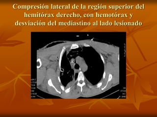 Compresión lateral de la región superior del
hemitórax derecho, con hemotórax y
desviación del mediastino al lado lesionado
 