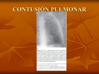 CONTUSIÓN PULMONAR
 