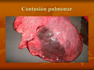 Contusión pulmonar
 