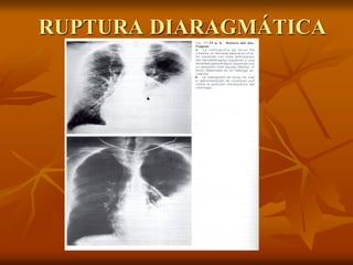 RUPTURA DIARAGMÁTICA
 