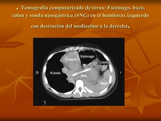 . Tomografía computarizada de tórax: Estómago, bazo,
colon y sonda nasogástrica (SNG) en el hemitórax izquierdo
con desviación del mediastino a la derecha.
 