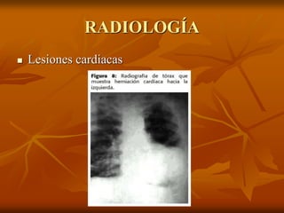 RADIOLOGÍA
 Lesiones cardiacas
 