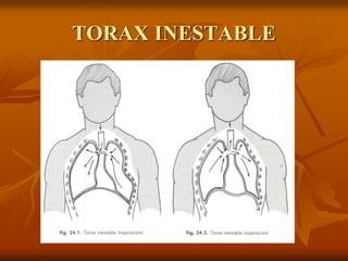 TORAX INESTABLE
 