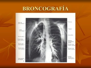 BRONCOGRAFÍA
 