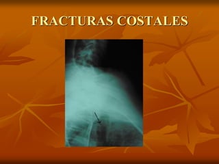 FRACTURAS COSTALES
 
