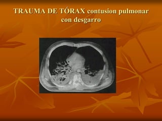 TRAUMA DE TÓRAX contusion pulmonar
con desgarro
 