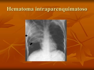 Hematoma intraparenquimatoso
 