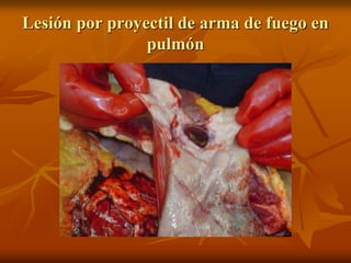 Lesión por proyectil de arma de fuego en
pulmón
 