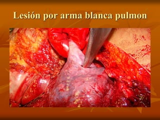 Lesión por arma blanca pulmon
 