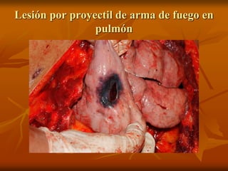 Lesión por proyectil de arma de fuego en
pulmón
 