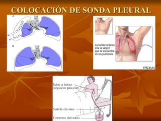 COLOCACIÓN DE SONDA PLEURAL
 