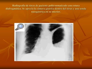 Radiografía de tórax de paciente politraumatizado con rotura
diafragmática. Se aprecia la cámara gástrica dentro del tórax y una sonda
nasogástrica en su interior.
 