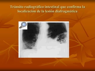 Tránsito radiográfico intestinal que confirma la
localización de la lesión diafragmática
 