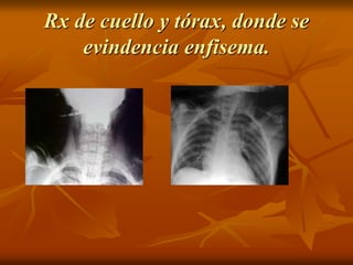 Rx de cuello y tórax, donde se
evindencia enfisema.
 