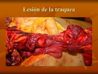 Lesión de la traquea
 