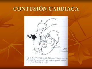 CONTUSIÓN CARDIACA
 