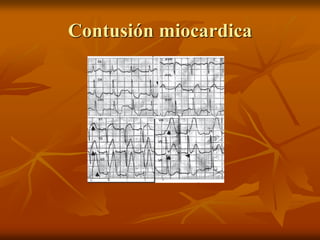 Contusión miocardica
 