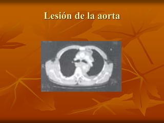 Lesión de la aorta
 